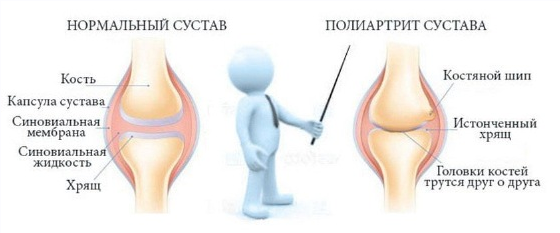 Игорь Кауфман Реаматоидный полиартрит 2022 слив курса