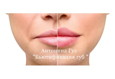 Антонина Гуз Бьютификация губ 2023 слив