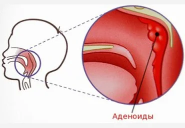 Аденоиды казнить нельзя помиловать - Леднева слив