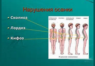 Правильная осанка - Бобкова слив