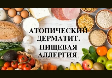 Регина Доктор Атопический дерматит. Пищевая аллергия слив