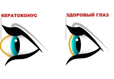 Людмила Лазарева Убираем кератоконус. Возвращаем нормальную форму глаз 2023 слив