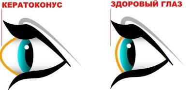 Людмила Лазарева Убираем кератоконус. Возвращаем нормальную форму глаз 2023 слив курса