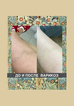 Наталия Травникова Варикоз 2025 слив