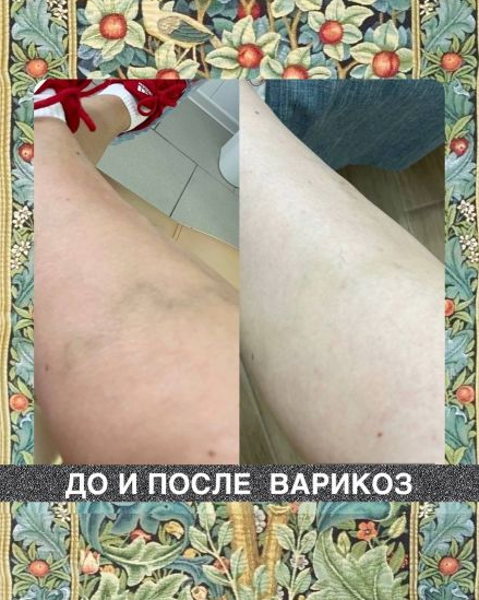 Наталия Травникова Варикоз 2025 слив курса