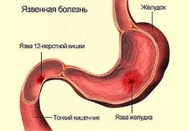 Лечение язвы желудка и 12-перстной кишки - Соболевская 2015 слив