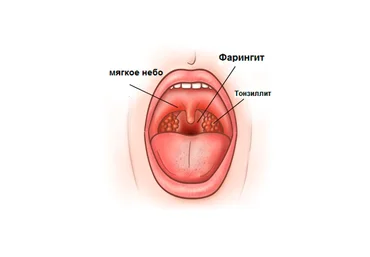 Игорь Атрощенко Диагностика и лечение тонзиллитов, ларингитов и фарингитов 2020 слив