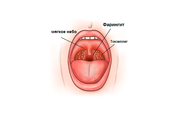 Игорь Атрощенко Диагностика и лечение тонзиллитов, ларингитов и фарингитов 2020 слив курса