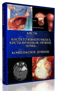 Мини инфопродукт №5. Кисты. Киста головного мозга, Кисты яичников, Печени, почек… Фролов слив курса